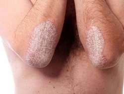 soigner le psoriasis